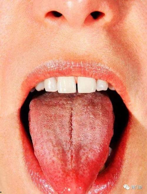 吃小瓜舌头裂纹